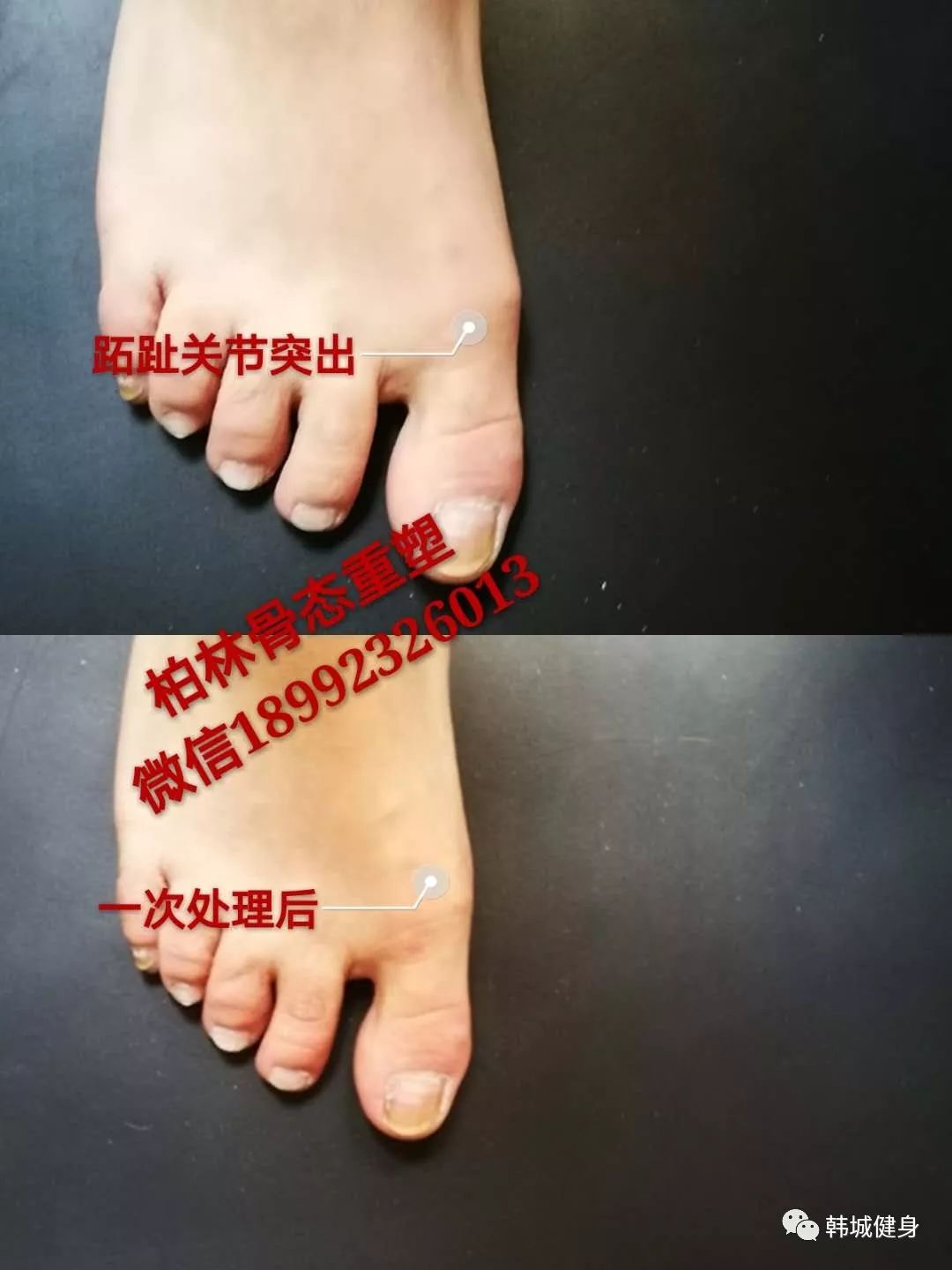 脚拇指外翻最新治疗方法，重塑自信与成就感的创新之旅