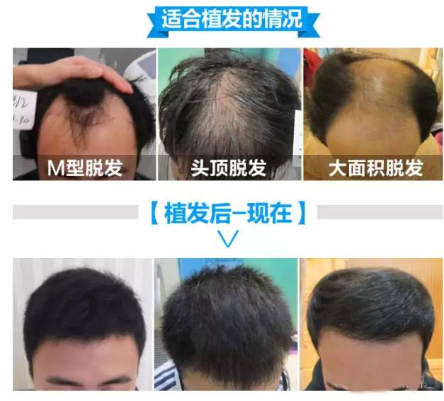 最新脱发治疗方法，全面观点分析解读